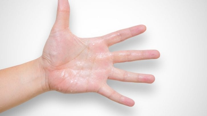 Facts about sweaty hands syndrome