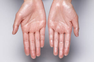 Sweaty Hands Clinic in Perth, WA