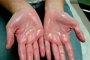 Sweaty Hand Treatment & Consultation in Perth